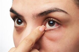 "سعود الطبية" توضح حقيقة استخدام القهوة في علاج متلازمة العين الجافة