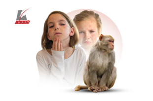هل يمكن إصابة الأطفال بفيروس جدري القرود ؟