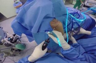 جراحة معقدة بالمنظار تعيد حركة مفصل الكتف لمريضة في نجران